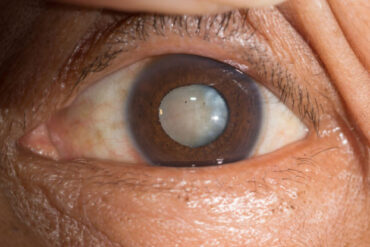 मोतियाबिंद होने का मुख्य कारण क्या है?, मोतियाबिंद क्या हैं और उनका इलाज कैसे किया जाता है?, क्या मोतियाबिंद दवा से ठीक हो सकता है?, सफेद मोतियाबिंद का इलाज कैसे करें?, glaucoma in hindi, cataract surgery, cataract meaning, types of cataract, मोतियाबिंद लेंस कीमत, बिना ऑपरेशन मोतियाबिंद का इलाज, मोतियाबिंद का ऑपरेशन कब करना चाहिए, मोतियाबिंद सर्जरी के बाद दृष्टि, मोतियाबिंद in English, मोतियाबिंद कितने प्रकार के होते हैं, मोतियाबिंद लेंस कीमत, मोतियाबिंद का ऑपरेशन कैसे होता है दिखाइए, मोतियाबिंद ऑय ड्रॉप्स, मोतियाबिंद की दवा, मोतियाबिंद क्यों होता है, मोतियाबिंद का ऑपरेशन कब करना चाहिए, आंख में मोतियाबिंद हो जाए तो क्या करना चाहिए?, मोतियाबिंद होने के क्या कारण है?, क्या मोतियाबिंद बिना ऑपरेशन के ठीक हो सकता है?, मोतियाबिंद का ऑपरेशन कब करना चाहिए?