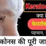 केराटॉकोनस (keratoconus) क्या है?, पहचान कैसे करें