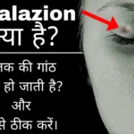 Chalazion क्या होता है? पलक की गांठ को कैसे ठीक करें और यह क्यू हो जाती है?