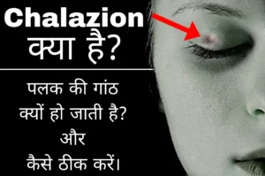 Read more about the article Chalazion क्या होता है? पलक की गांठ को कैसे ठीक करें और यह क्यू हो जाती है?