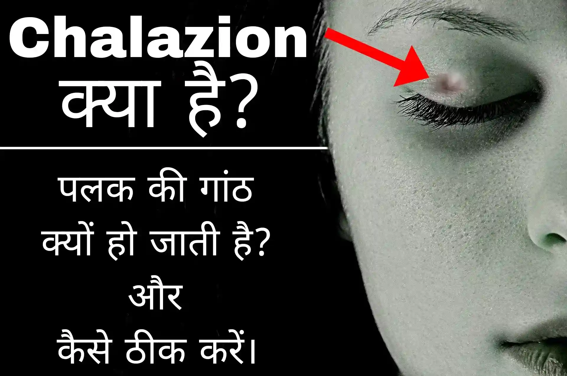 You are currently viewing Chalazion क्या होता है? पलक की गांठ को कैसे ठीक करें और यह क्यू हो जाती है?